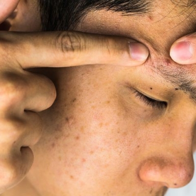 3 Tips on How to Treat Adult Acne